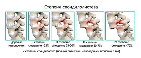 Расстройства чувствительности и ослабление мышц при смещении позвонка в задней части межпозвоночного диска