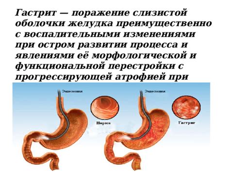 Расшифровка результатов гастроскопии при развитии язвенной патологии желудка