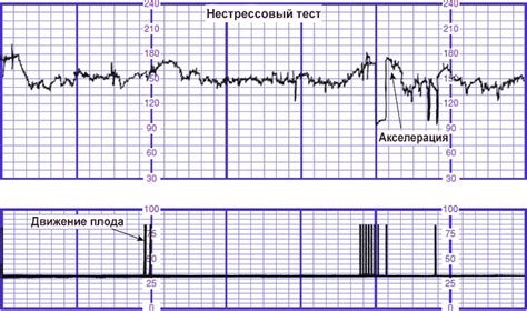 Результаты и преимущества нестрессового теста ареактивного