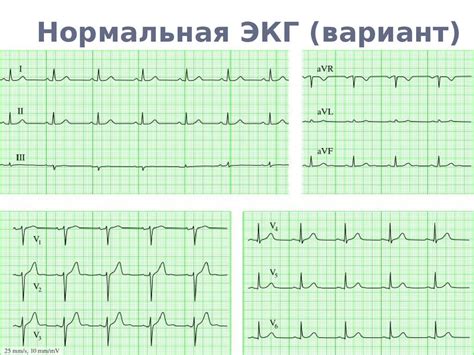 Роль одиночной жэс на ЭКГ в диагностике сердечных недугов