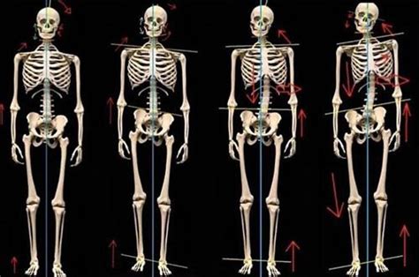 Роль осанки в происхождении выступа на шее