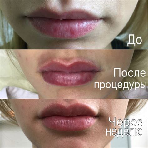Салонные процедуры для уменьшения отеков после процедуры увеличения губ