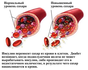 Сахар в крови и физическая активность