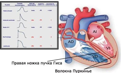 Сердечные заболевания, вызывающие нарушение проводимости по правой ножке пучка Гиса