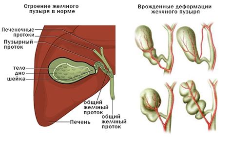 Симптомы и возможные причины перекручивания желчного пузыря