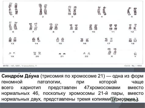 Симптомы и признаки, отражающие наличие 47-й хромосомы