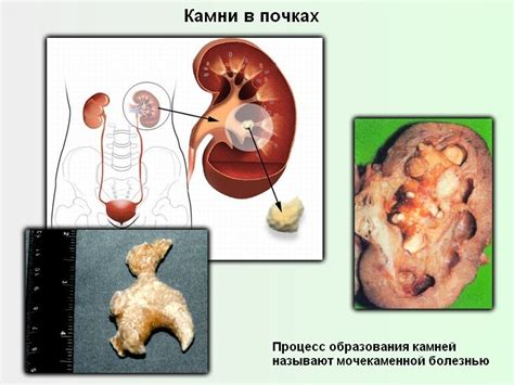 Симптомы и причины образования камня в почке