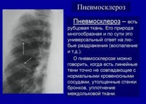 Симптомы неравномерной пневматизации легочной паренхимы