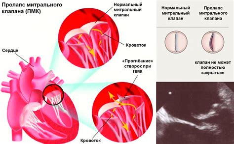 Симптомы несостоятельности остиального клапана