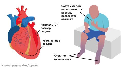 Симптомы неспецифической внутрижелудочковой блокады сердца