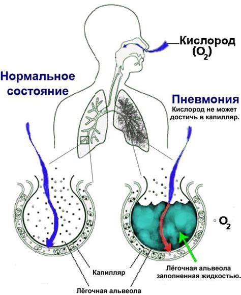 Симптомы обеих полостей легких наполняются жидкостью