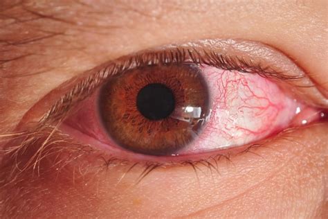 Симптомы частого мигания глаз