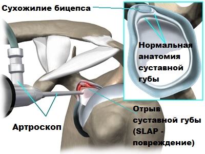 Техники нанесения специальных лент для различных травматических повреждений плечевого сустава