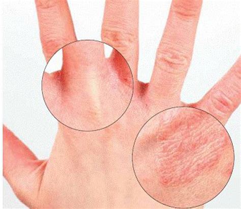 Удаление химического пятна после применения космофена на коже рук ребенка
