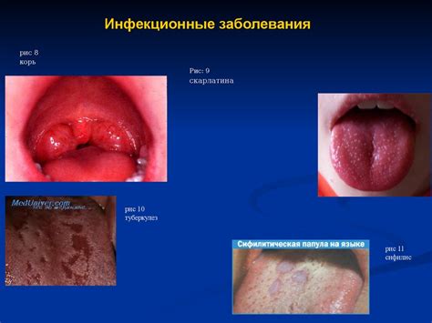 Уменьшение воспаления и отёка слизистой оболочки