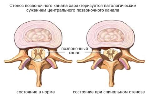 Участие в образовании позвоночного канала