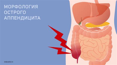 У всех пациентов с острым аппендицитом температура обязательно повышена.