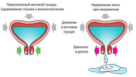 Факторы, влияющие на частое выделение мочи у представителей stronger sex