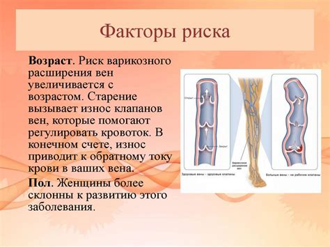 Факторы риска и профилактика варикозного расширения вен