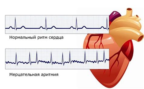 Формирование аритмии сердца как результат парной экстрасистолии