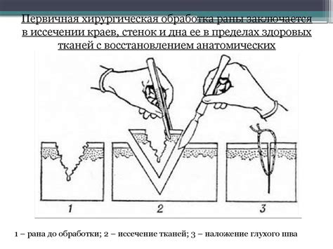 Частые погрешности при обработке раны и способы избежать их