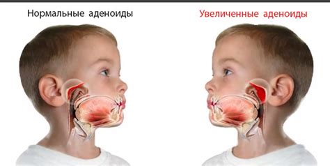 Что такое аденоиды и как их состояние влияет на здоровье ребенка