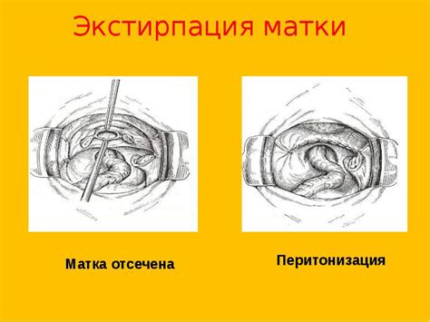 Что такое нервосберегающая экстирпация?