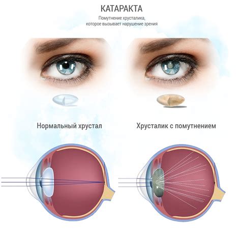 Что такое несозревшая катаракта?