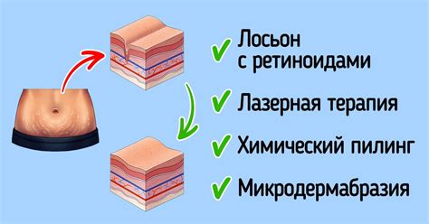 Что такое растяжки и почему они возникают?