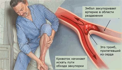 Эмболия в малых и больших сосудах: основные различия