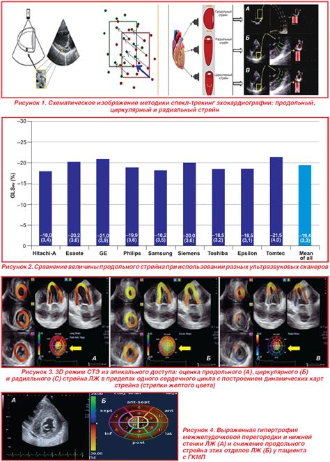 Эффективность эхокардиографии в диагностике и контроле сердечных заболеваний