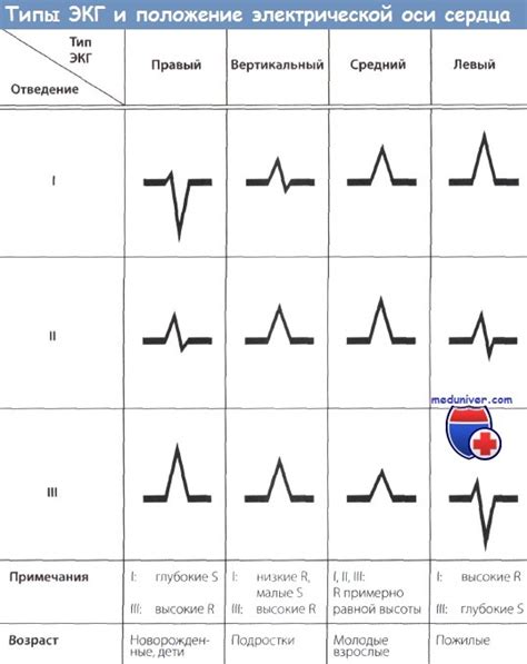  Влияние отклонений ЭОС на интерпретацию ЭКГ 