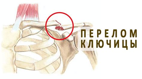  Возможные факторы, способствующие проявлению треска или шуршания в области ключицы во время движения плеча 