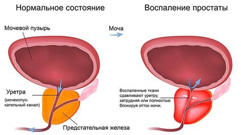  Воспаление предстательной железы 