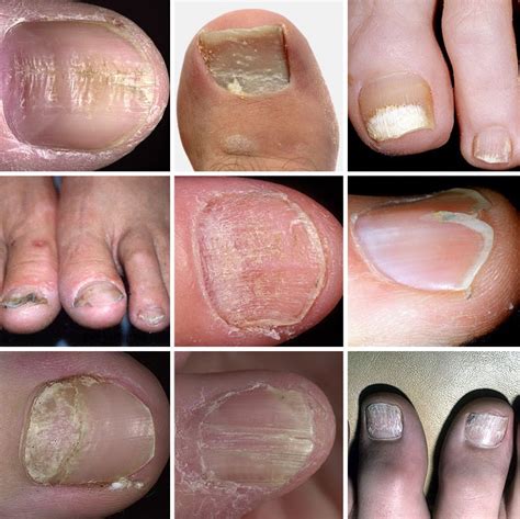 Вредные привычки и их негативное воздействие на состояние ногтей